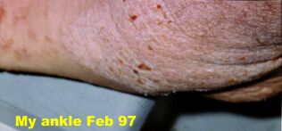 Atopic dermatitis is often called eczema.