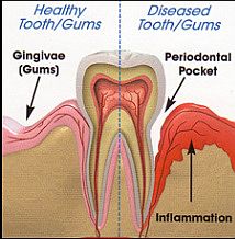 Periodontal