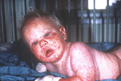 eczema child vaccinosis