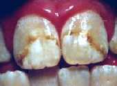 Dental fluorosis