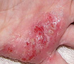 Atopic dermatitis is a long-term skin disease.